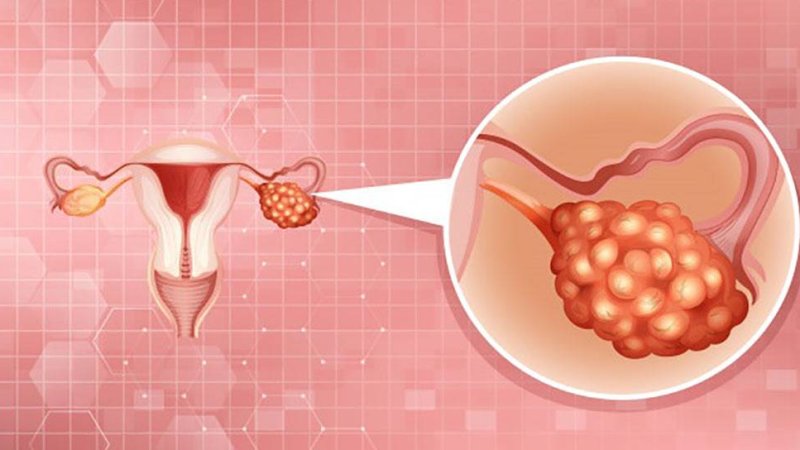 د تخمدان سرطان وپېژنئ!