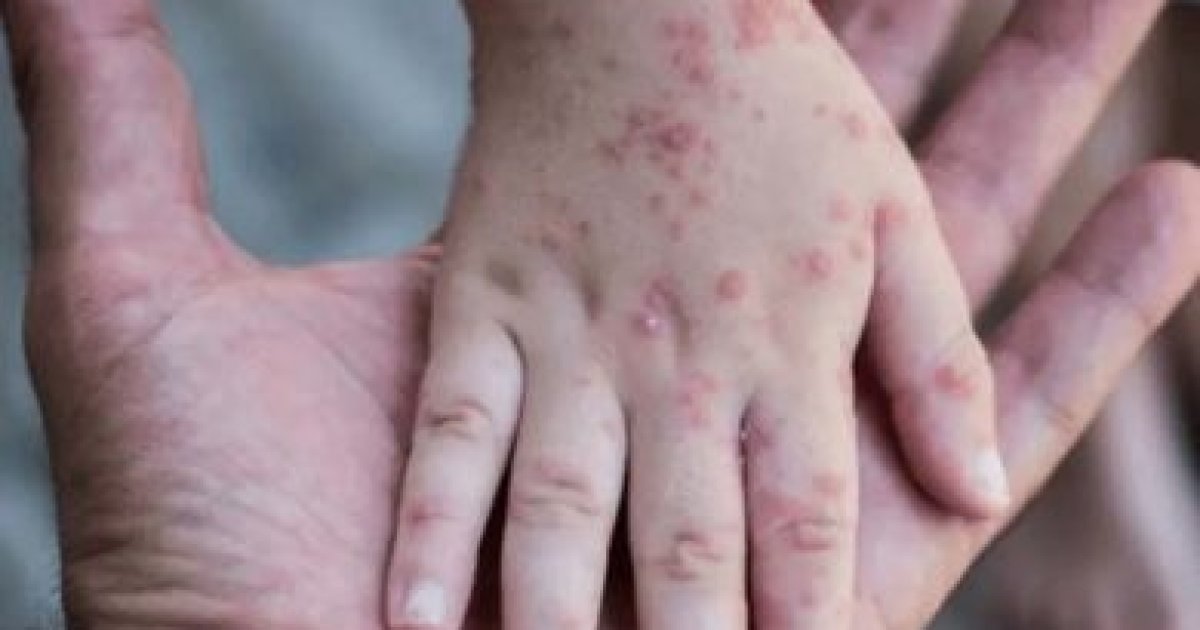 د بيزو تڼاکې څه ډول ناروغي ده؟