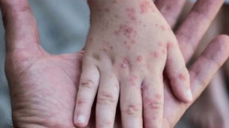 د بيزو تڼاکې څه ډول ناروغي ده؟