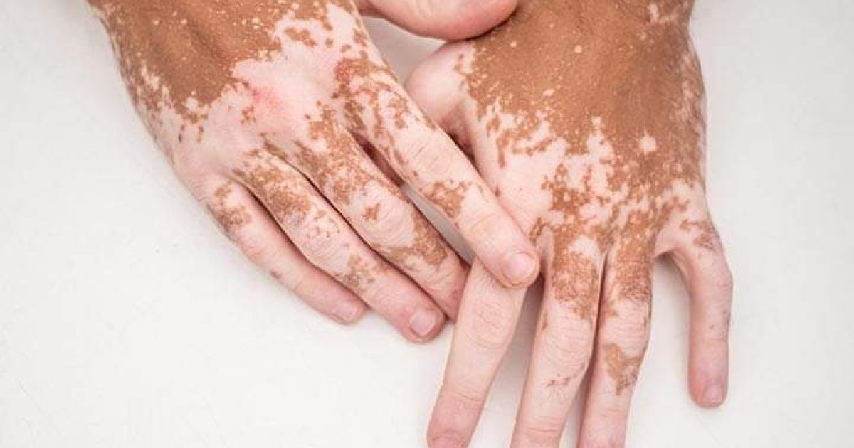 Vitiligoپیس مرض او اعلاج یی