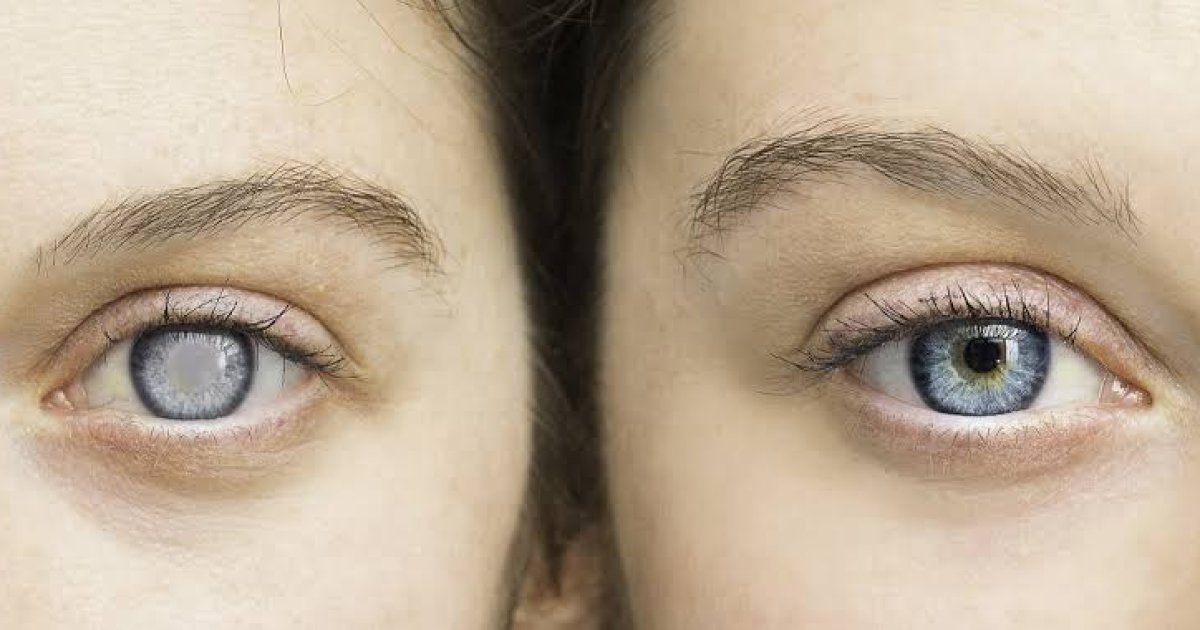 ګلوکوما څه ډول ناروغي ده؟