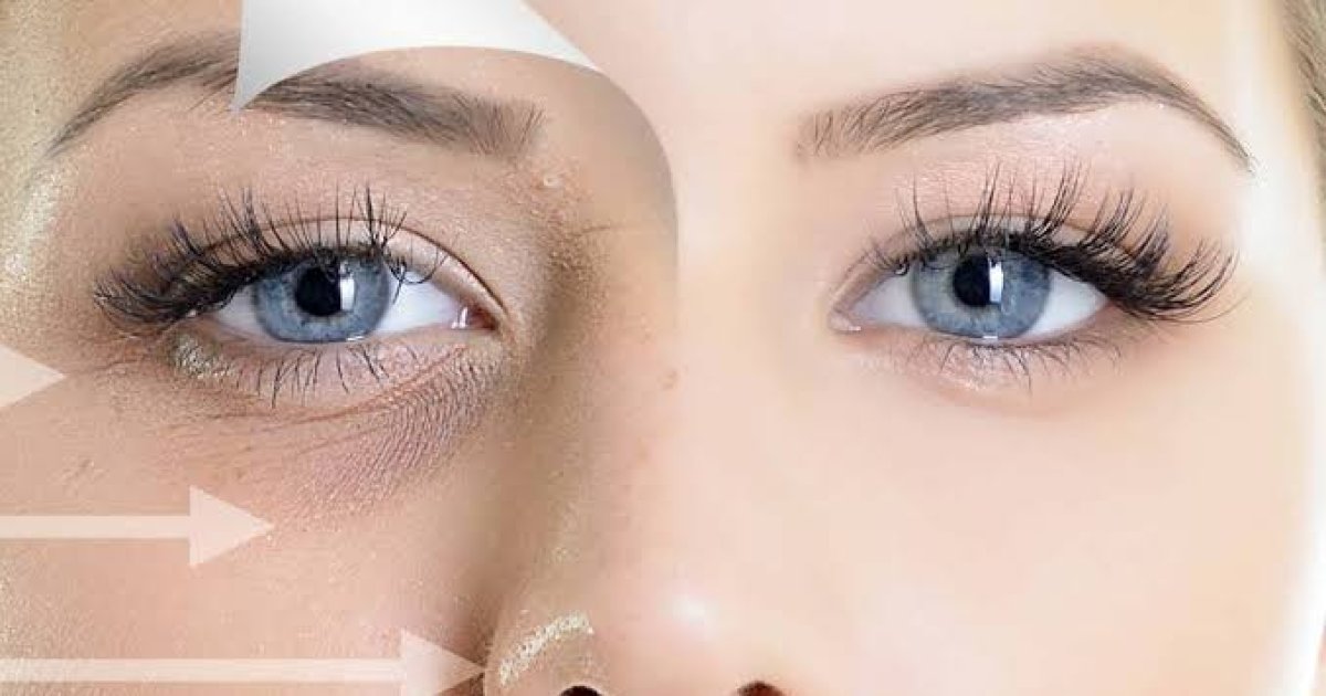 د سترګو شاوخوا توروالی څنګه له منځه یوسو؟