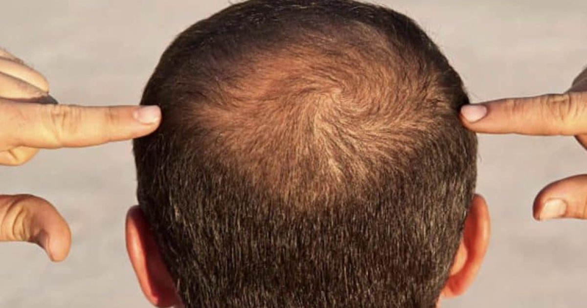 د ویښتانو تویېدنې ځينې لامولونه!